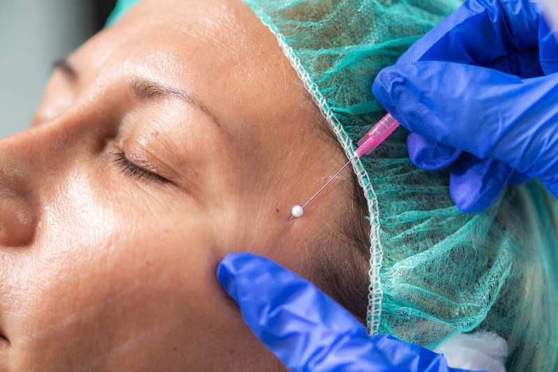 Gloved hands guiding a fine cannula at the temple of a woman in a surgical cap, her eyes closed